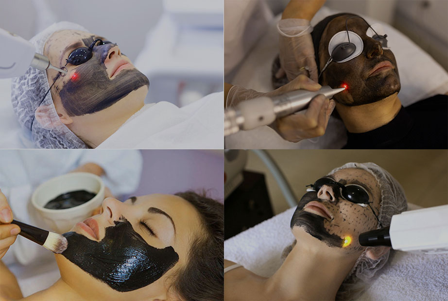 Carbon Laser Facials